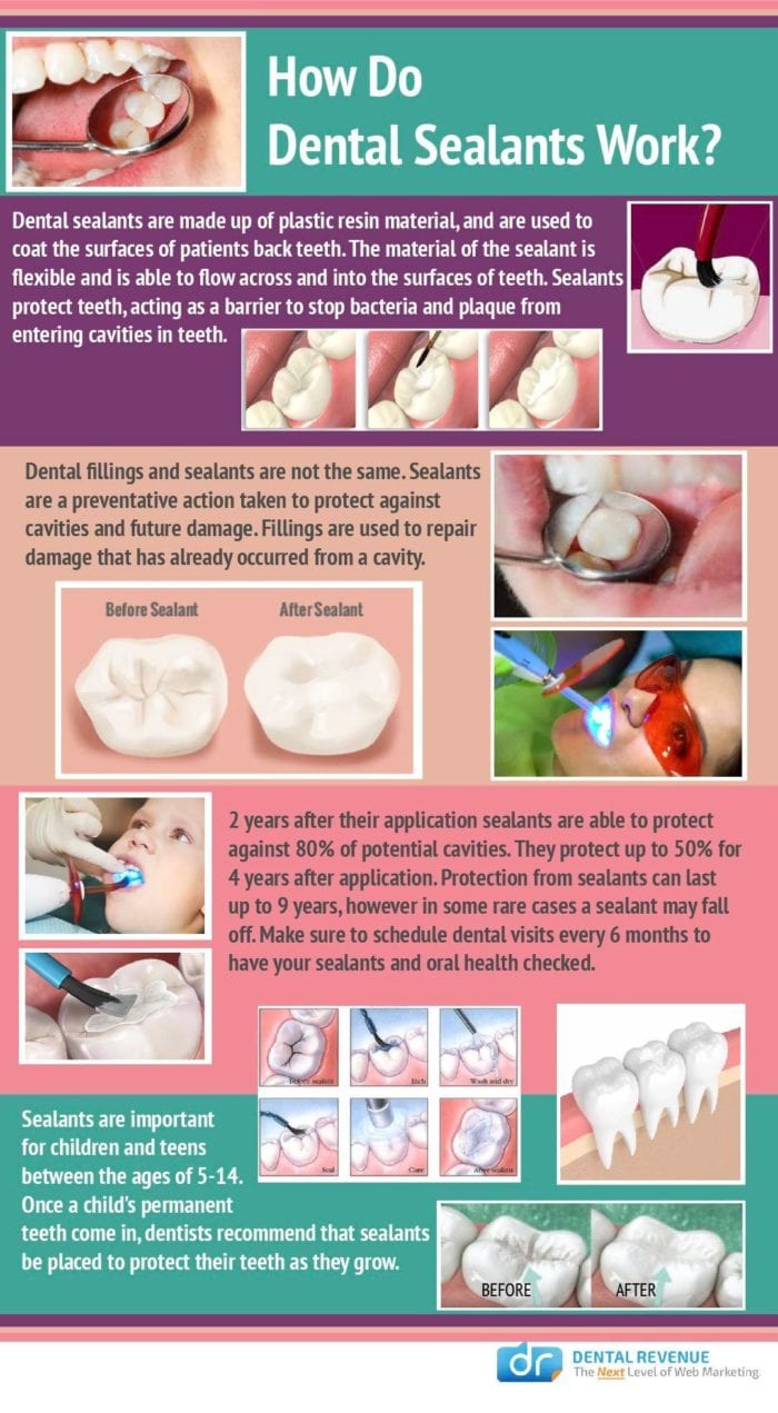 Do You Need A Dental Filling?, Cavity Fillings